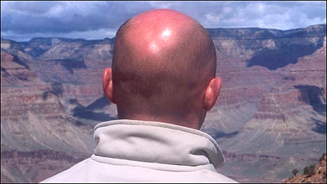 Cause of Baldness 科學(xué)家揭曉禿頭的原因